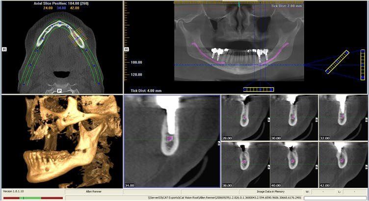 Onlay Ramus Block Bone Grafting | Prosthodontist Overland Park, KS