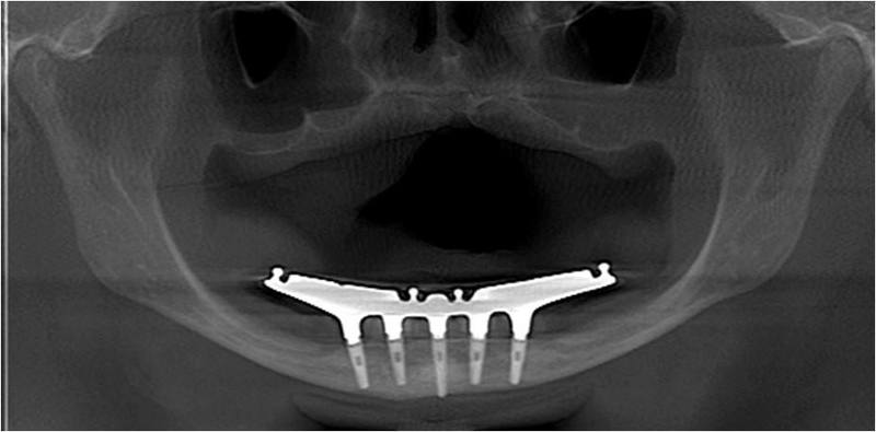 Post-Op Radiograph