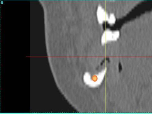 Pre-Op CT Scan Cross (1)