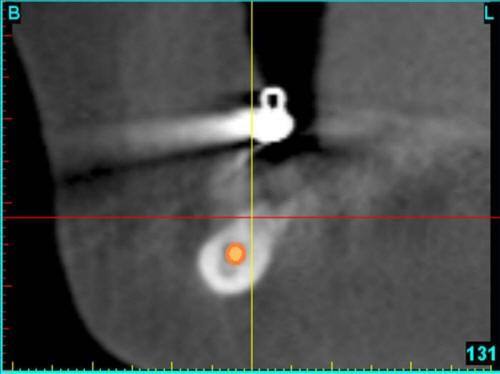 Pre-Op CT Scan Cross (2)