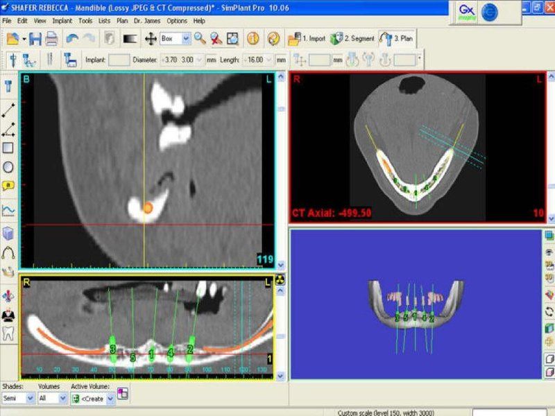 Pre-Op CT Scan