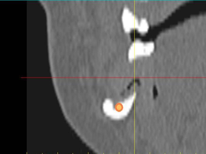 Pre-Op CT