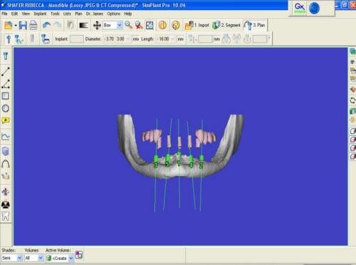 Pre-Op 3D (1)