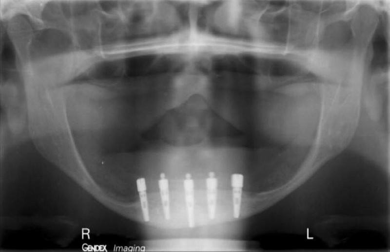 Post-Surgery Radiograph